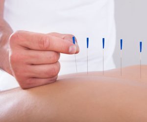 Acupunctura